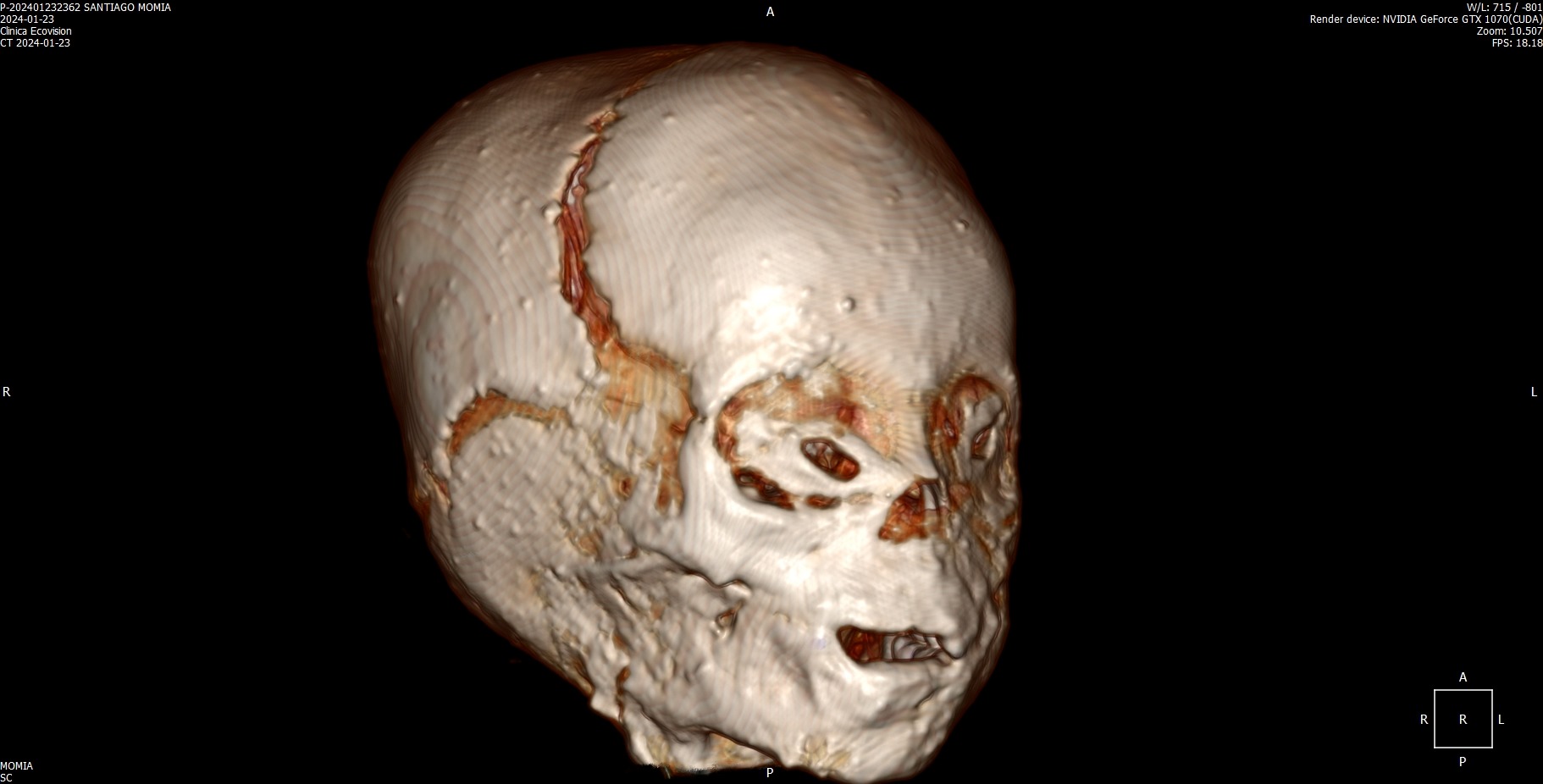 Medical Scan of Santiago