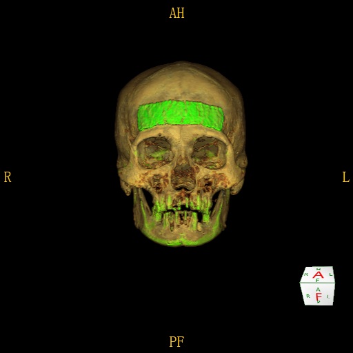 Loose skulls CABEZA 1 IMPLANTE CT rendering